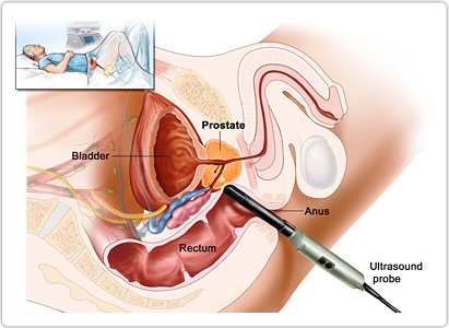 Prostate Cancer Diagnostics Market Report Analysis Overview Upto 2023
