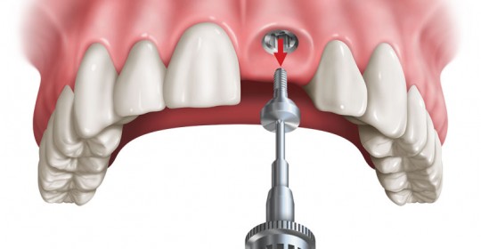 Global Implant Abutment Market In-Depth Research Report - Historical data and Forecast 2018 to 2023