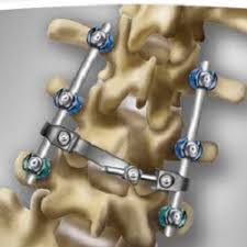 Global Osteosynthesis Devices Market Research Report 2017