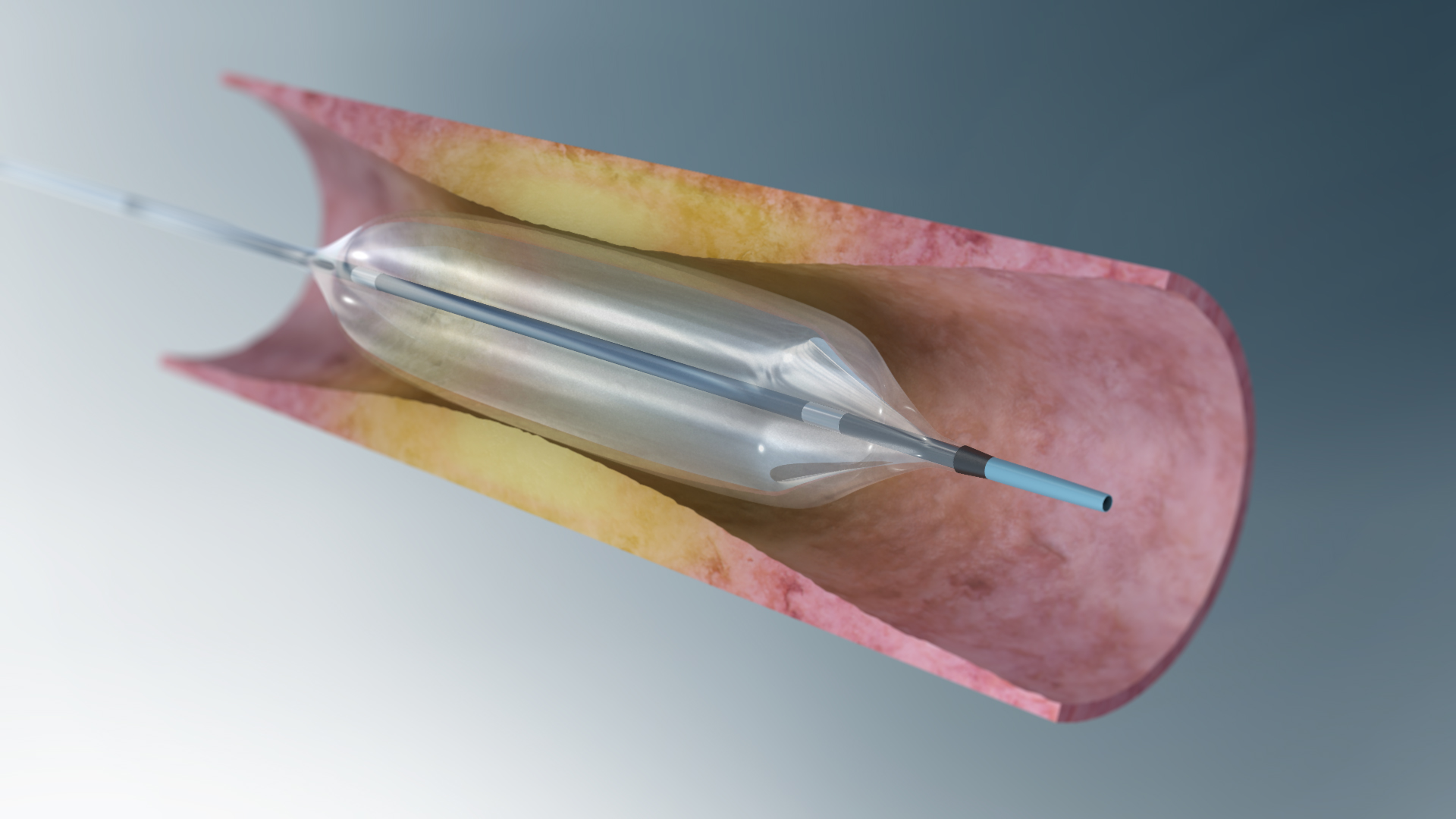 Global and Chinese Cardiovascular Balloon Catheters Market Outlook 2018 Growth, Trends, Forecasts 2022