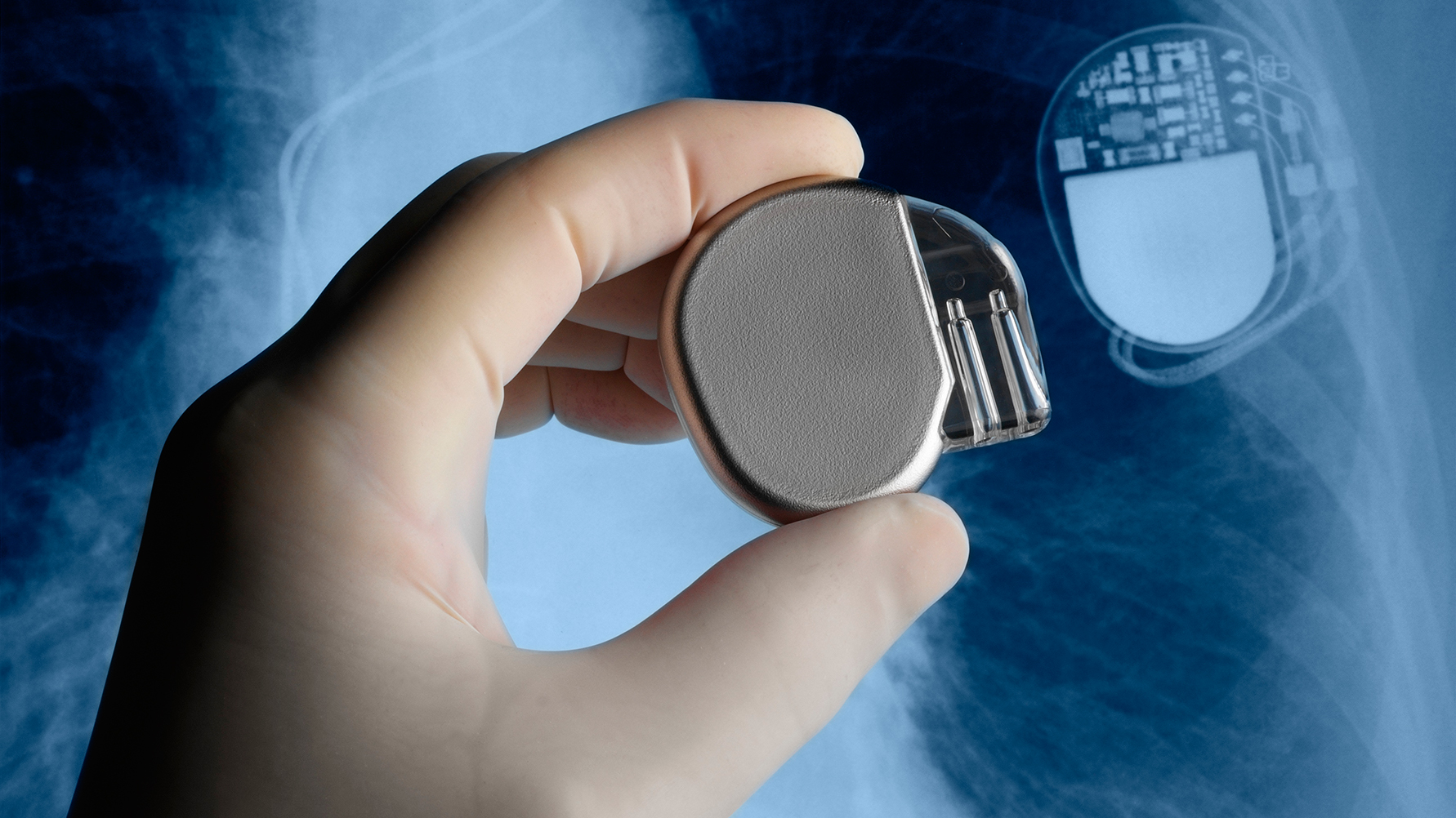Global Implantable Medical Devices Market Research Report 2017- Johnson & Johnson Medtronic Danaher Corporation