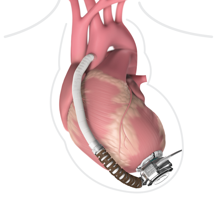 Global Heart Pump Devices Market Set For Rapid Growth And Trend 2018-2025