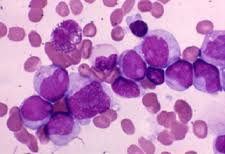 Leukemia Therapeutics Market-Manufacturers, Trend, Global Industry Report and Forecast 2025