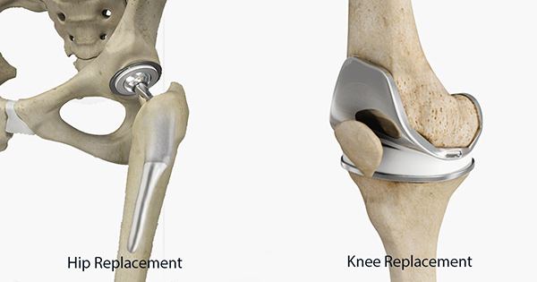 Global Joint Replacement Market 2019 Manufacturers, Regions, Type and Application, Forecast to 2024