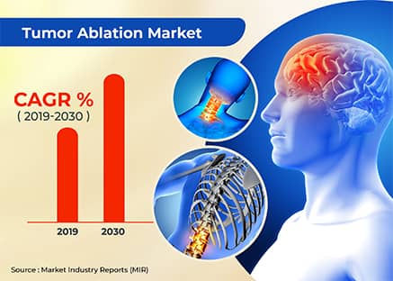 Tumor Ablation Market 2019 Emerging Trends & Top Players Analysis 2030: Galil Medical Inc, Sonacare Medical, NeuWave Medical, AngioDynamics, Medtronic