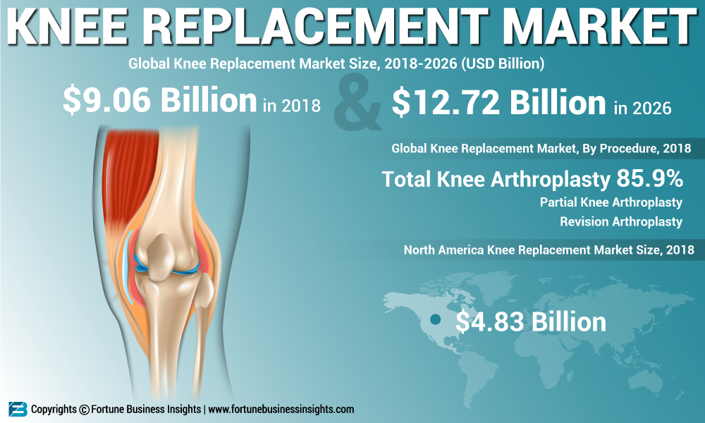 Knee Replacement Market Analysis, Statistics, Industry Growth, Top Key Players, Regional Overview, projections till 2026
