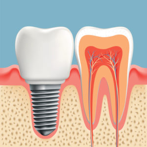 Dental Prosthetic & Implant Consumables Market | Global Industry Analysis, Size, Share, Growth, Trends Forecasts 2026