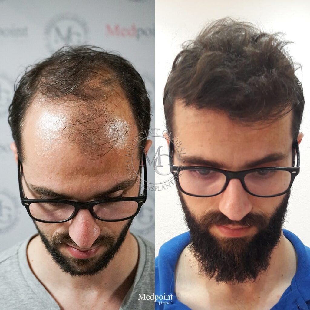 Hair Transplant in indore